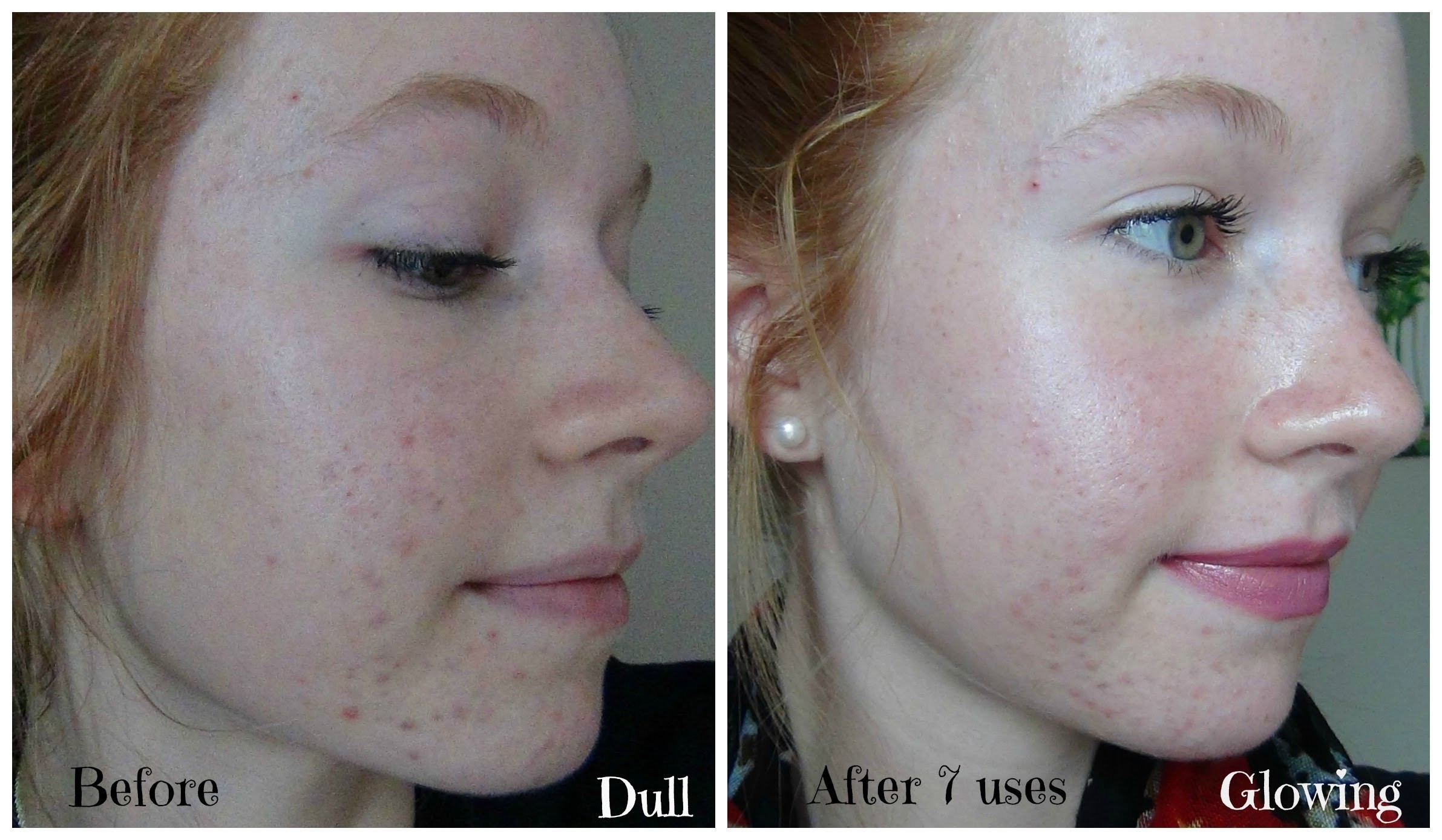 Personal Microderm Review! PMD Demo and Before & After Pictures!