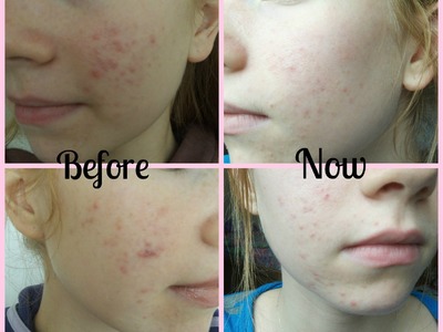 My Natural Skin Care Routine For Acne - Part 1! How to Clear Acne Naturally ♥