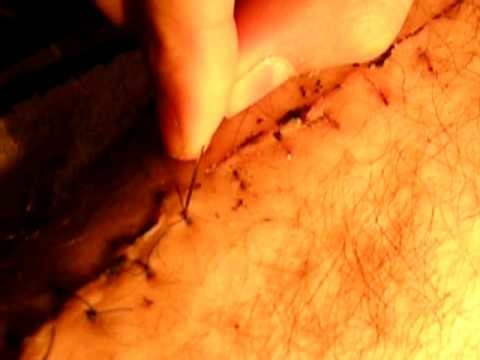 DIY Stitches Removal