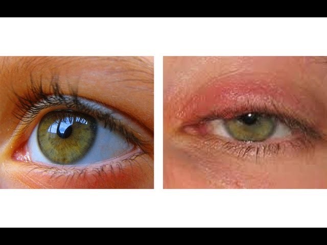HOW TO CURE AN EYE INFECTION IN 24 HOURS!