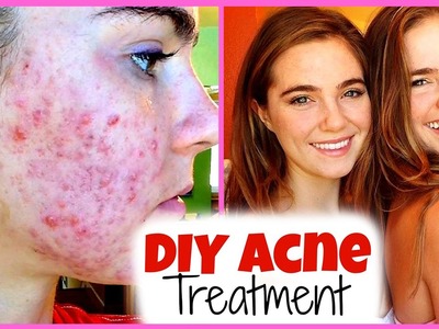 DIY Acne Treatment with Nina and Randa!