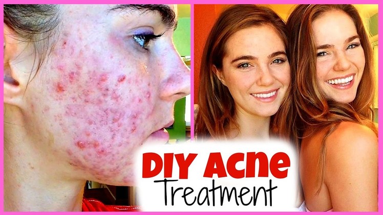 DIY Acne Treatment with Nina and Randa!