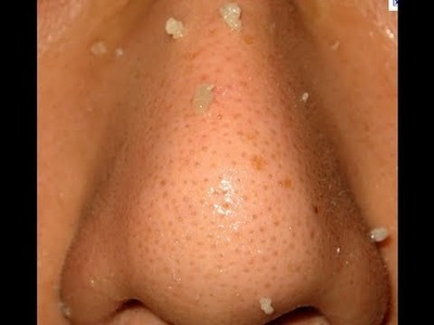 Get rid of blackheads and clogged pores WARNING GRAPHIC banishacnescars.com