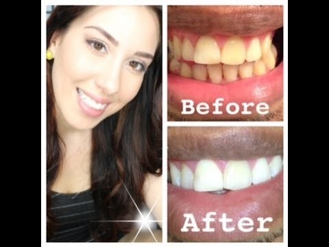 How to whiten EXTREMELY yellow teeth at home (with actual pictures)