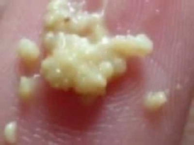 How To Remove Tonsil Stones