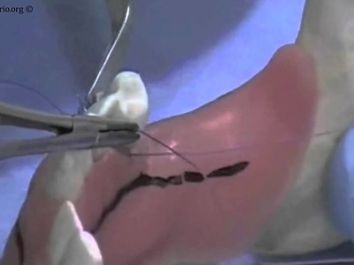 How to suture External Mattress Suture