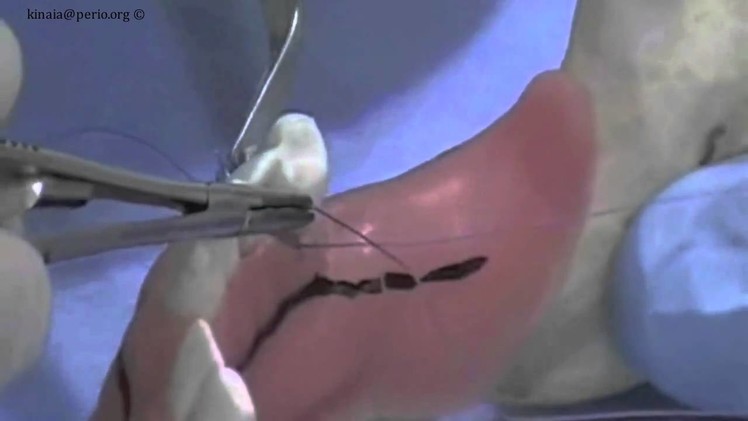 How to suture External Mattress Suture