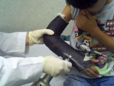 7 year old getting cast off. (pic of broken arm at 2:15). PG-13