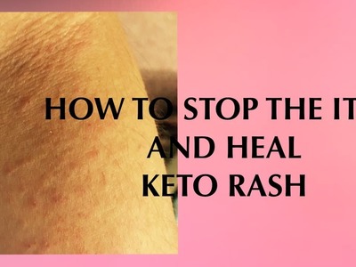 HOW TO HEAL KETO RASH
