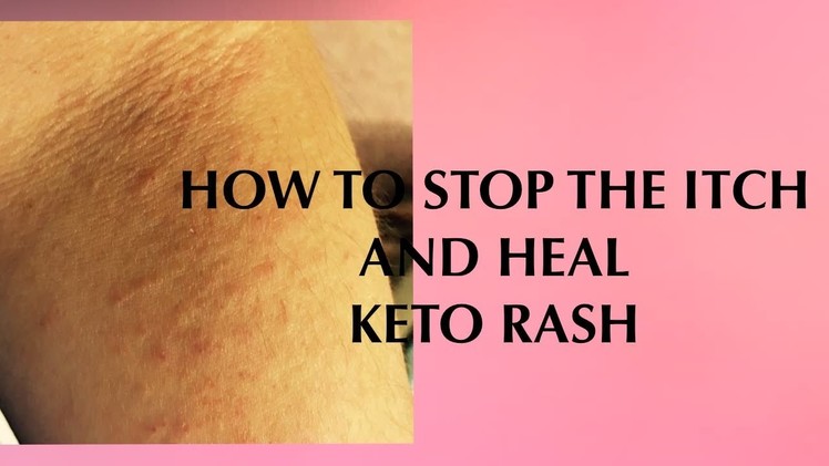 HOW TO HEAL KETO RASH
