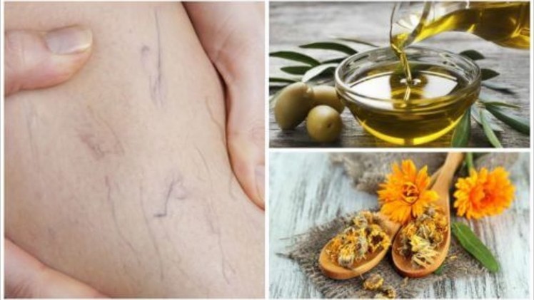 How to Get Rid of Varicose Veins With Olive Oil and Marigold Treatment ! Natural Remedies