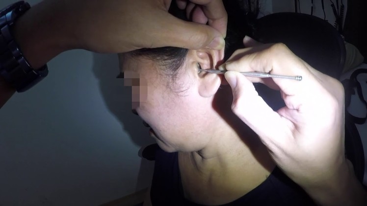 Watch how to properly remove ear wax using ear curette